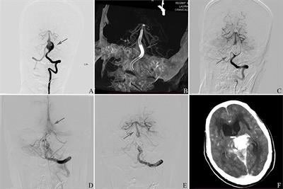 Pipeline Embolization Device for the Treatment of Unruptured Intracranial Dissecting Aneurysms